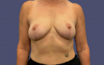 Breast Lift 2 After